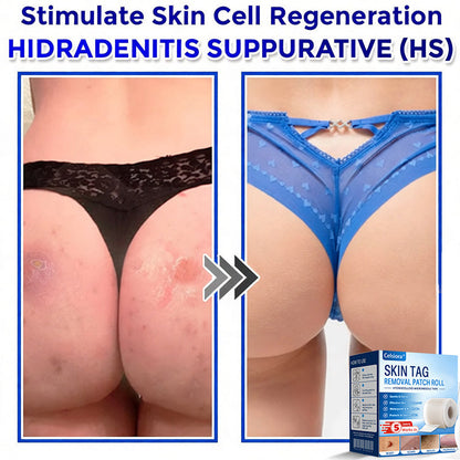 👩‍⚕️👩‍⚕️Celsiora® Multi-Functional Microneedle Hydrocolloid Patch Roll | Targets Skin Tags, Warts & Stubborn Blemishes
