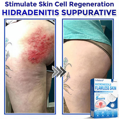 ☘️☘️Celsiora® 2-in-1 Microneedle & Hydrocolloid Patch | Raised Moles,Acne, Flat Warts & Skin Tags Remover | Improves Wrinkles, Scars & Blemishes | Invisible Pimple Patches for Face & Body | 24 Count