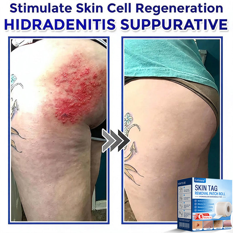 👩‍⚕️👩‍⚕️Celsiora® Multi-Functional Microneedle Hydrocolloid Patch Roll | Targets Skin Tags, Warts & Stubborn Blemishes