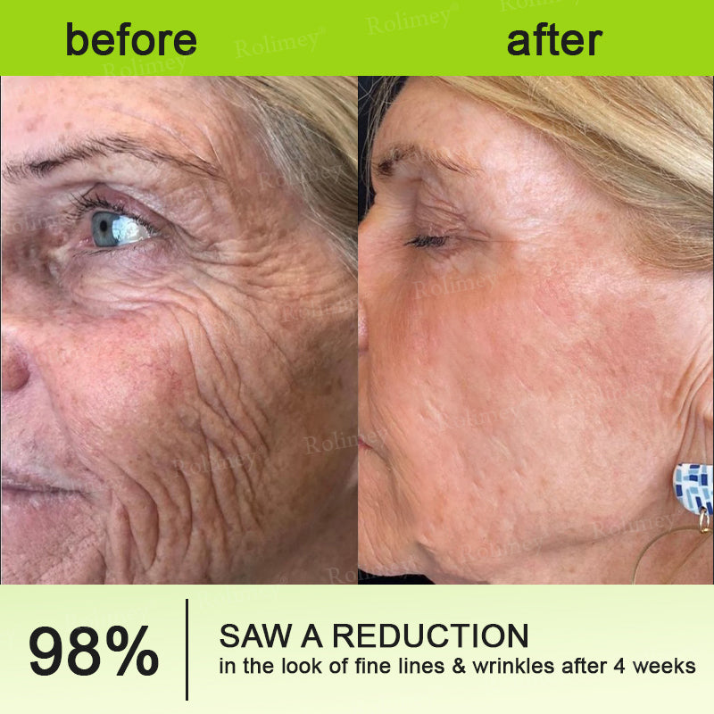 ❤️👑Made and shipped from Australia 💫Rolimey® Botox & Vita-A Retinol Shot Wrinkle-Lift Tightening cream - Last Day Promotion 50% OFF