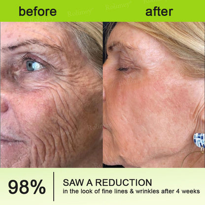 ❤️👑Made and shipped from Australia 💫Rolimey® Botox & Vita-A Retinol Shot Wrinkle-Lift Tightening cream - Last Day Promotion 50% OFF