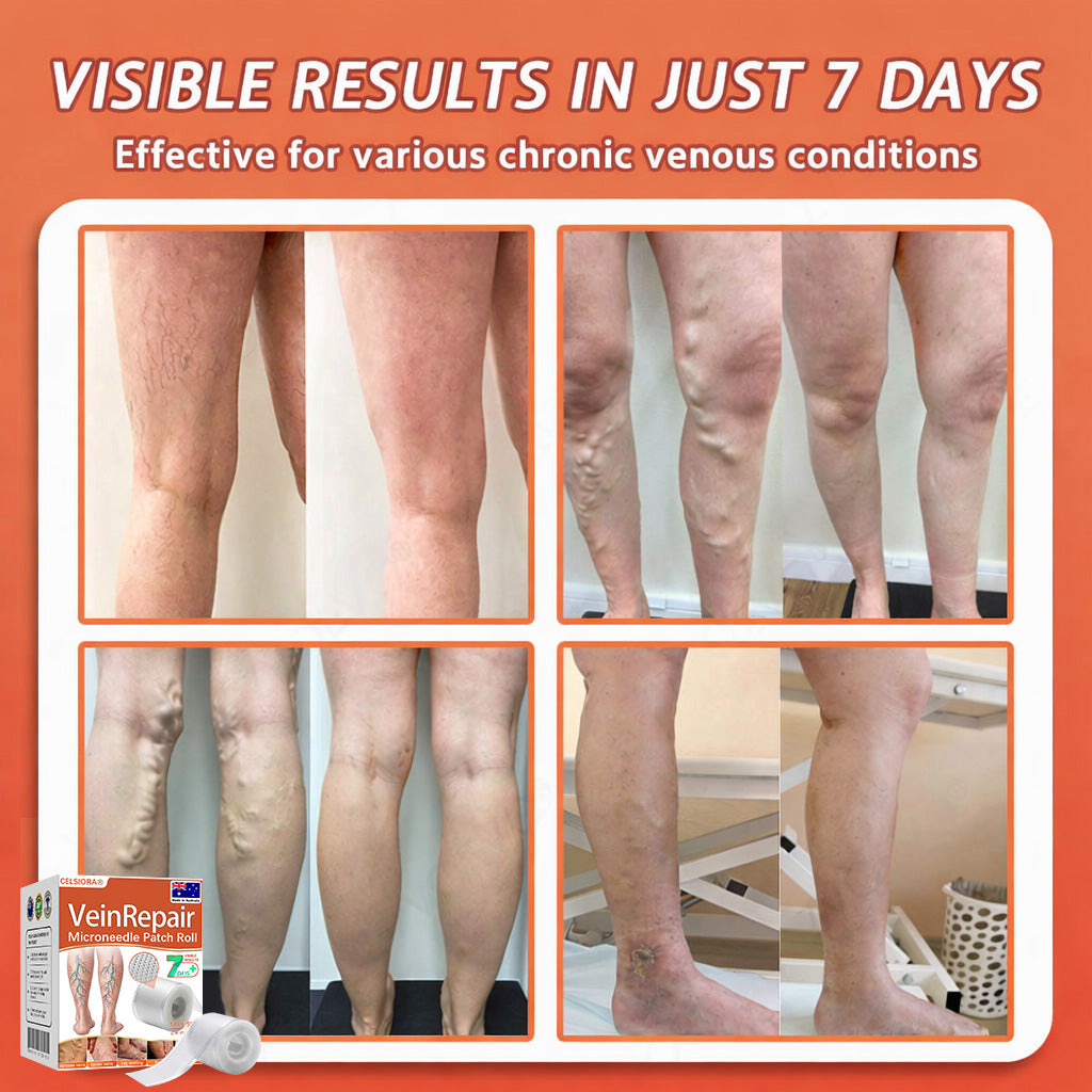 🌟🌟Celsiora® Vein Ease Microneedle Care Patch(For Spider Veins, Varicose Veins, Swelling & Leg Fatigue) - Last Day Promotion 50% OFF