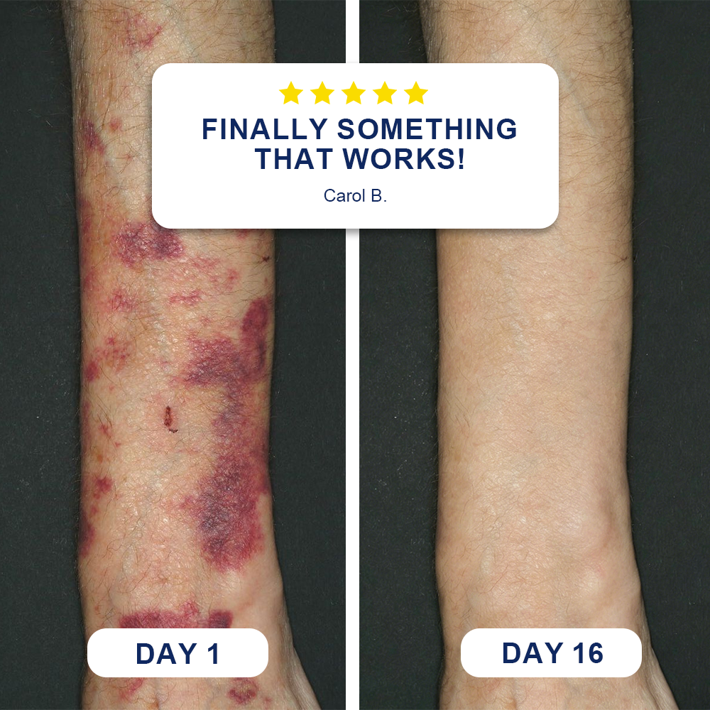 👩‍⚕️🌿Evolvion® Bruise Repair Cream-Advanced daily care for bruise-prone skin