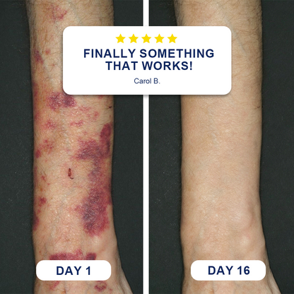 👩‍⚕️🌿Evolvion® Bruise Repair Cream-Advanced daily care for bruise-prone skin