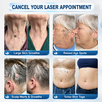 ✨🍃Evolvion® 7-Day Skin Tag & Spot Eraser Painless & Scar-Free Advanced Imperfection Remova𝗜 Ro𝗜𝗜erba𝗜𝗜 Pen