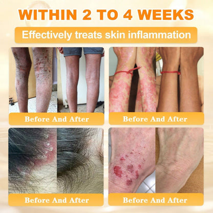 👨‍⚕️Rolimey® Bee Venom Skin Restoration Cream (Anti-aging, Hydrating, Skin Repair, Even Tone, Acne and Dark Spot Treatment, Wart and Mole Removal, Psoriasis Relief)