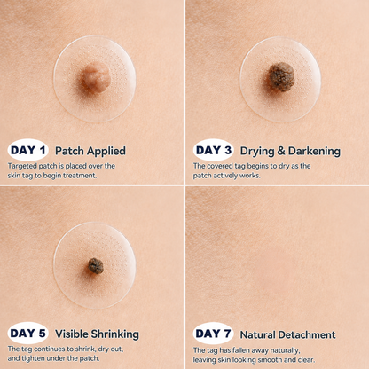 👩‍⚕️👩‍⚕️Celsiora® 2-in-1 Microneedle & Hydrocolloid Mole Removal Patch(Zero Pain, Zero Scars patch)
