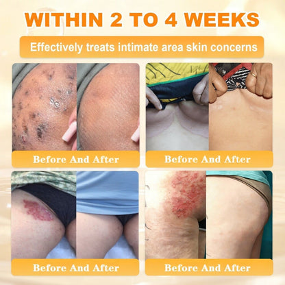 👨‍⚕️Rolimey® Bee Venom Skin Restoration Cream (Anti-aging, Hydrating, Skin Repair, Even Tone, Acne and Dark Spot Treatment, Wart and Mole Removal, Psoriasis Relief)