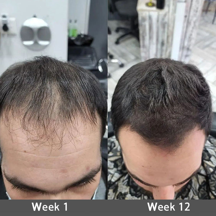 🌿🌿 Official AU Store 🇦🇺 | 🔥Rolimey® Highly Effective Biotin & Rosemary Hair Growth Serum — (🔥 Limited-Time Offer, ⏳ Last Day Promotion 50% OFF)
