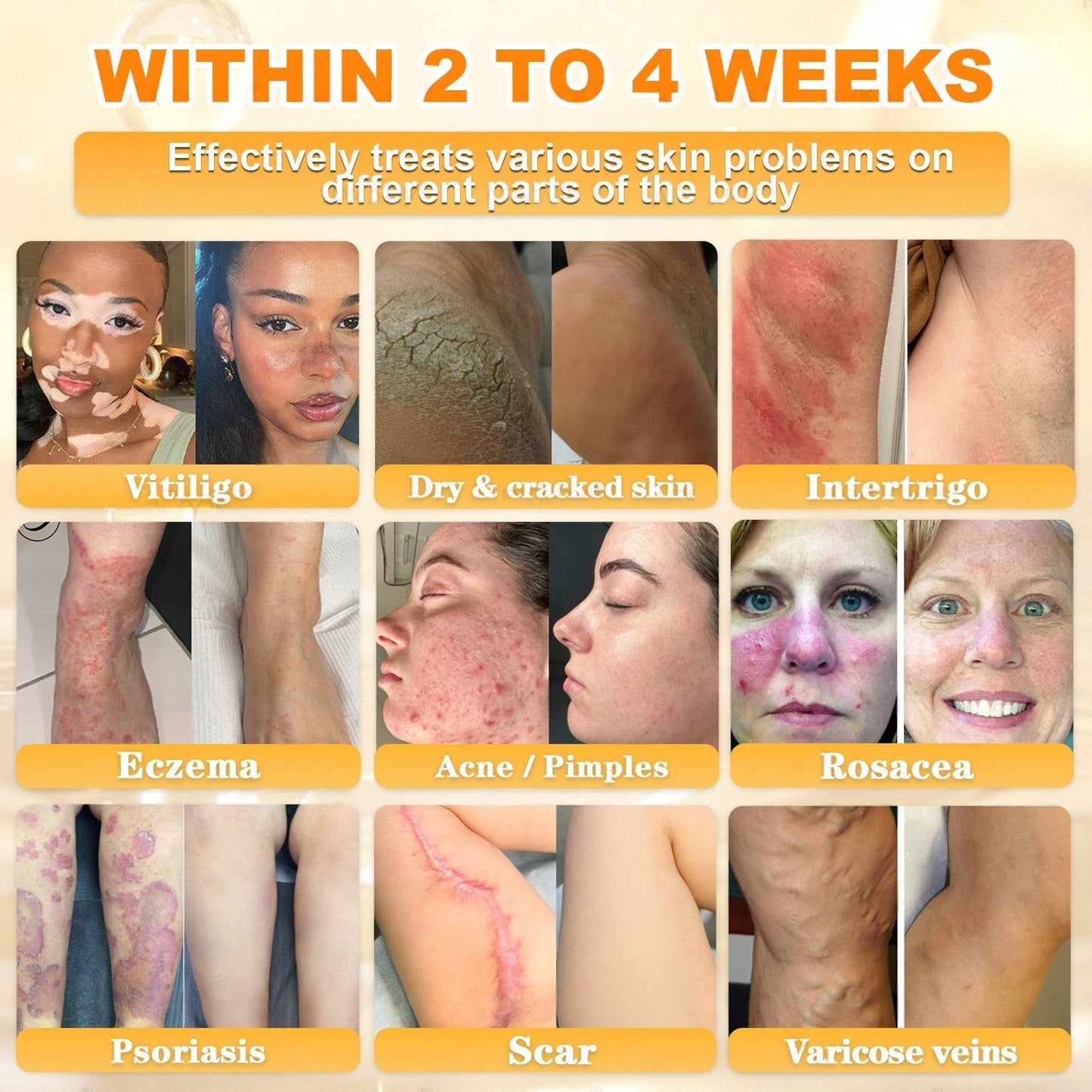 👨‍⚕️Rolimey® Bee Venom Skin Restoration Cream (Anti-aging, Hydrating, Skin Repair, Even Tone, Acne and Dark Spot Treatment, Wart and Mole Removal, Psoriasis Relief)