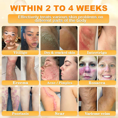 👨‍⚕️Rolimey® Bee Venom Skin Restoration Cream (Anti-aging, Hydrating, Skin Repair, Even Tone, Acne and Dark Spot Treatment, Wart and Mole Removal, Psoriasis Relief)