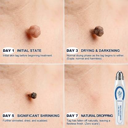 ✨🍃Evolvion® 7-Day Skin Tag & Spot Eraser Painless & Scar-Free Advanced Imperfection Remova𝗜 Ro𝗜𝗜erba𝗜𝗜 Pen