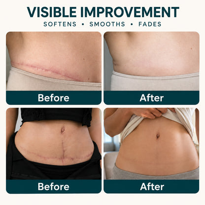 ✨🦄TRILUMIA® SILICONE SCAR THERAPY ROLL Help Soften, Flatten & Improve the Appearance of Raised Scars