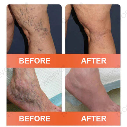 👨‍⚕️🌿Zvoevo® Vein Ease Microneedle Care Patch(For Spider Veins, Varicose Veins, Swelling & Leg Fatigue) - Last Day Promotion 50% OFF