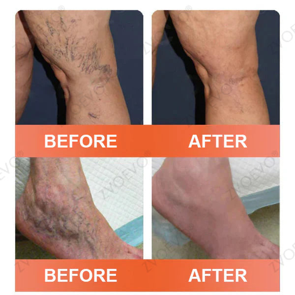 🌟🌟Celsiora® Vein Ease Microneedle Care Patch(For Spider Veins, Varicose Veins, Swelling & Leg Fatigue) - Last Day Promotion 50% OFF