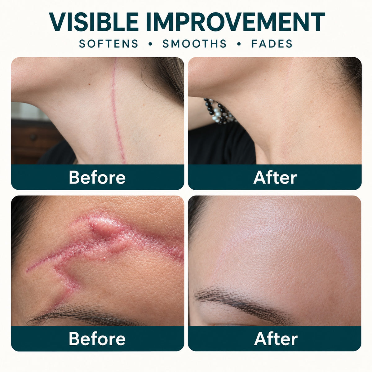 ✨🦄TRILUMIA® SILICONE SCAR THERAPY ROLL Help Soften, Flatten & Improve the Appearance of Raised Scars