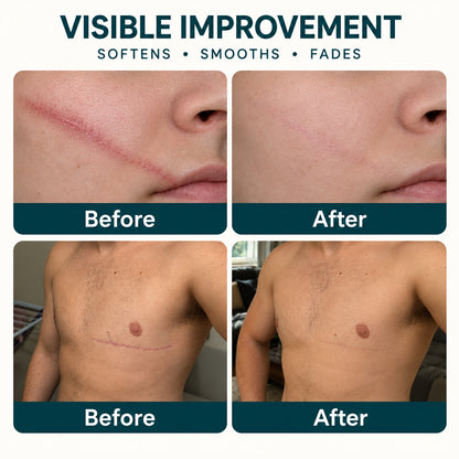✨🦄TRILUMIA® SILICONE SCAR THERAPY ROLL Help Soften, Flatten & Improve the Appearance of Raised Scars