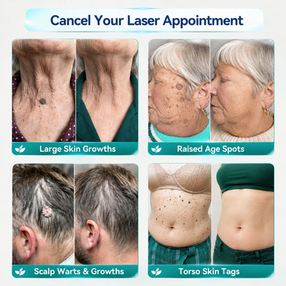 👩‍⚕️👩‍⚕️Celsiora® 2-in-1 Microneedle & Hydrocolloid Mole Removal Patch(Zero Pain, Zero Scars patch)