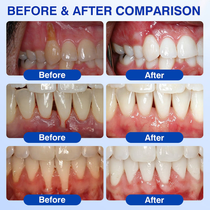 🇦🇺🌿🦷 Evolvion® GumCare Pro Advanced Gum Care Gel