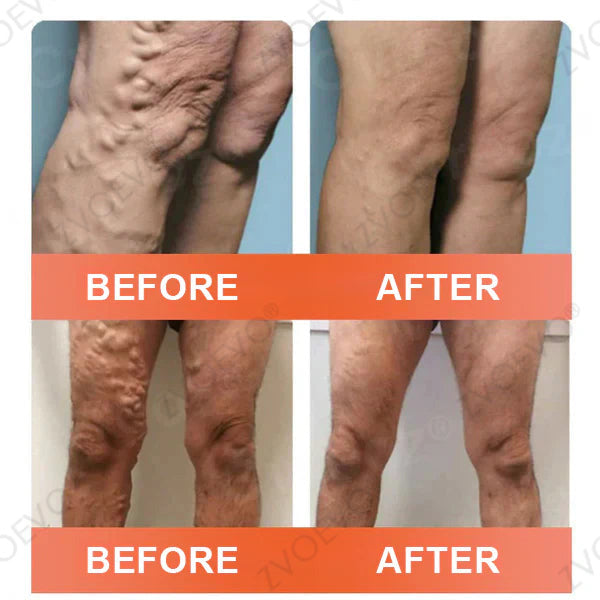 👨‍⚕️🌿Zvoevo® Vein Ease Microneedle Care Patch(For Spider Veins, Varicose Veins, Swelling & Leg Fatigue) - Last Day Promotion 50% OFF