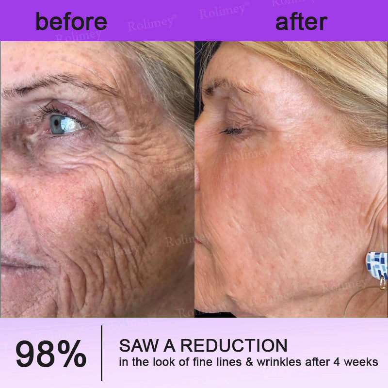 ✨ 💫Rolimey® NAD+ Retinol Firming & Lifting Cream – For Eye Bags, Dark Circles & Fine Lines | Last Day Sale: 60% OFF